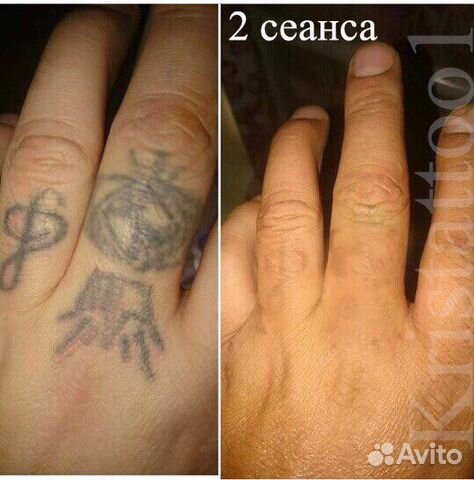 Удаление тату. Удаление татуажа Удаление тату. Удаление татуажа