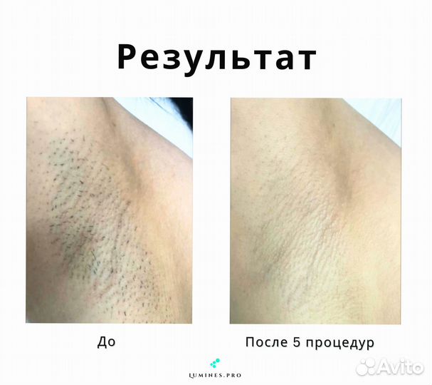 Аппарат для эпиляции lumines Max’One 1200в