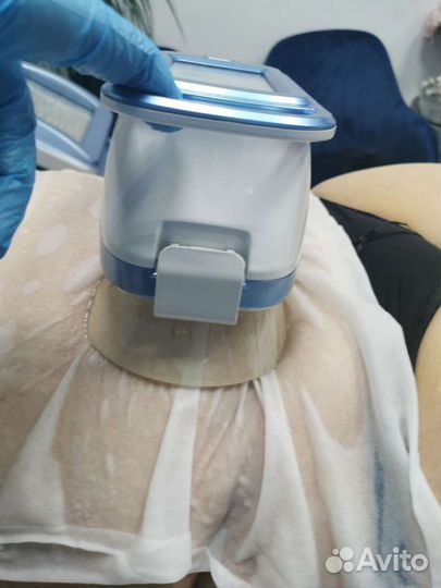 Криолиполиз, кавитация, LPG массаж, Липолазер, RF