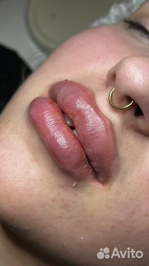 Увеличение губ