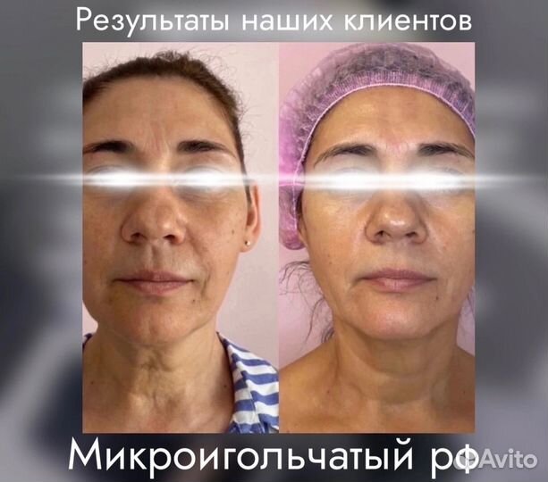 Микроигольчатый RF-лифтинг