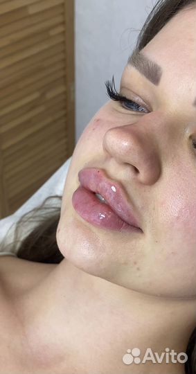 Модели на увеличение губ и контурную пластику лица