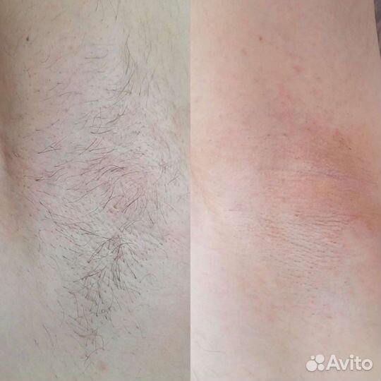 Депиляция воском, сахаром