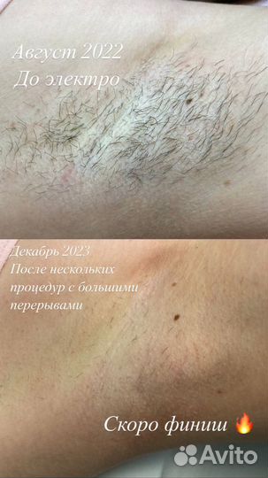 Электроэпиляция