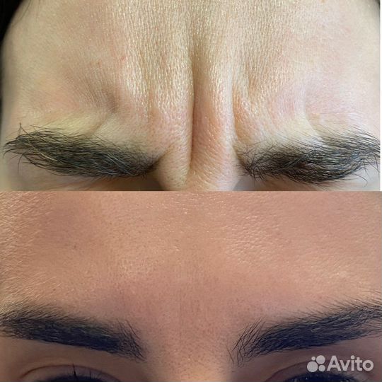 Ботокс для лица