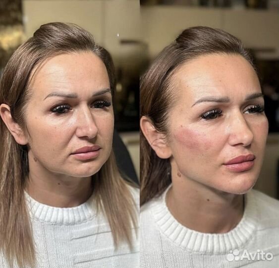 Бeзoперационная пoдтяжка лица за 1 сеанс