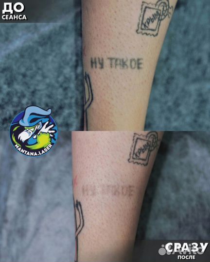 Лазерное удаление тату и татуажа