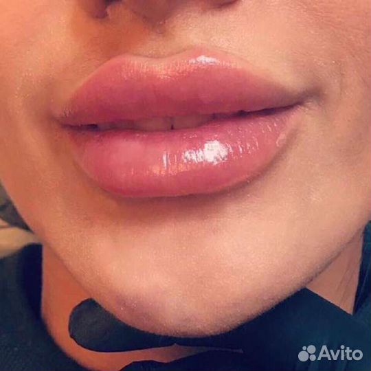 Увеличение губ