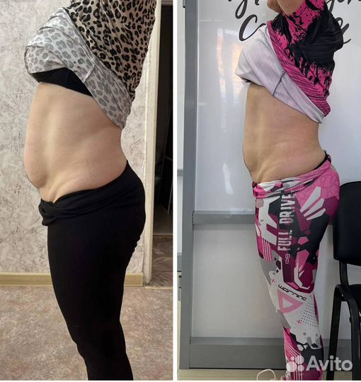 Похудение липолитиками