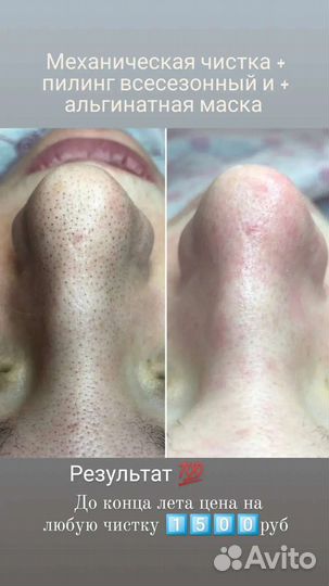 Чистка лица