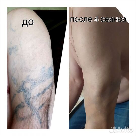 Удаление тату и татуажа лазером, карбоновый пилинг