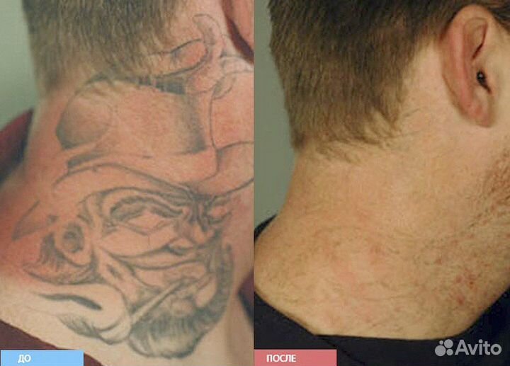 Лазерное удаление тату