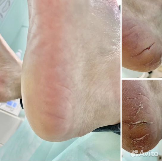 Педикюр,подолог,вросшие ногти