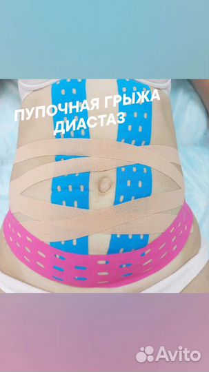 Тейпирование живота обучение