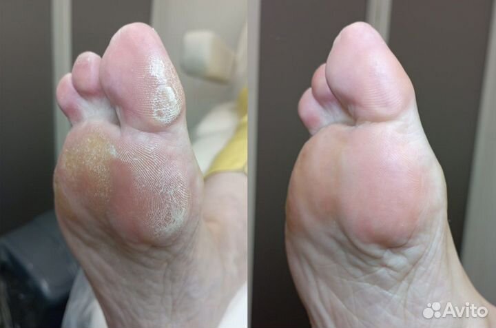 Лечебный (медицинский) педикюр подолог