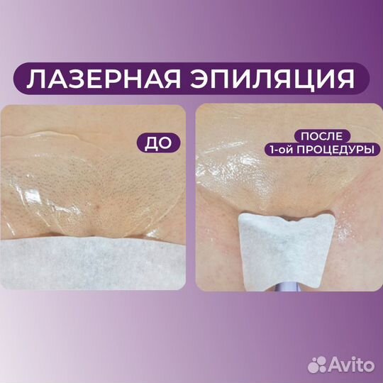 Лазерная эпиляция