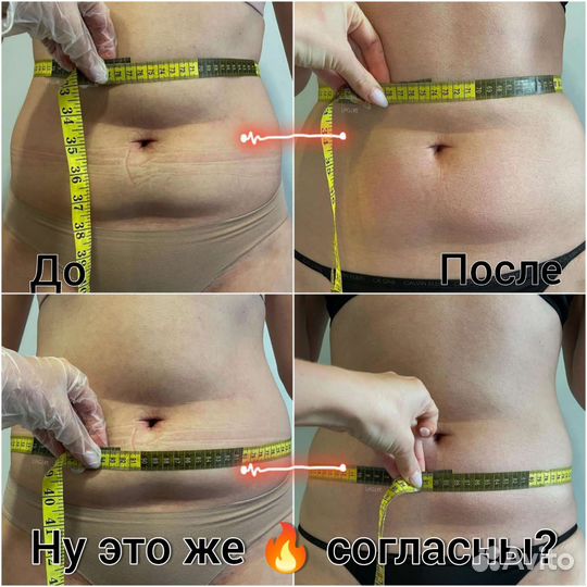 Lpg массаж, коррекция фигуры