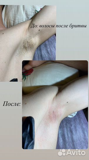 Депиляция, шугаринг