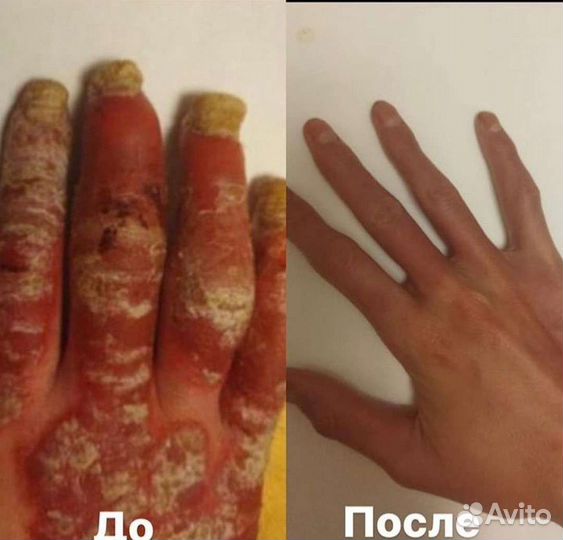 Средство от псориаза