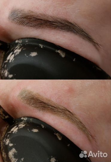 Лазерное удаление татуажа