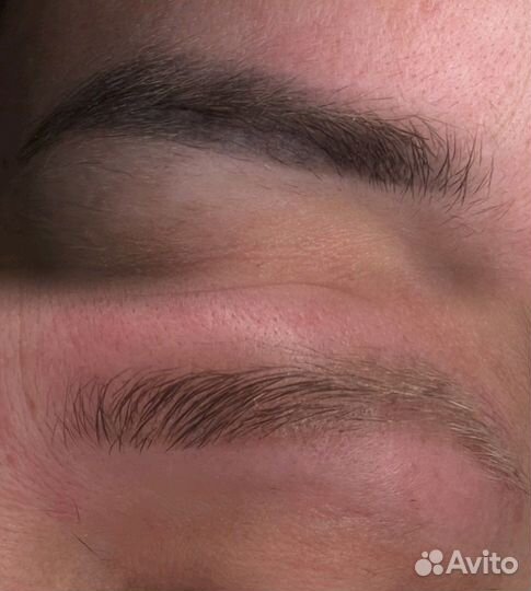 Удаление Татуажа и тату