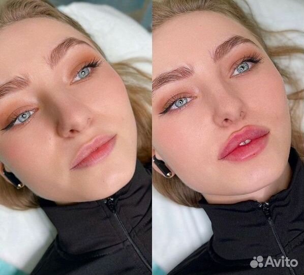 Увеличение губ