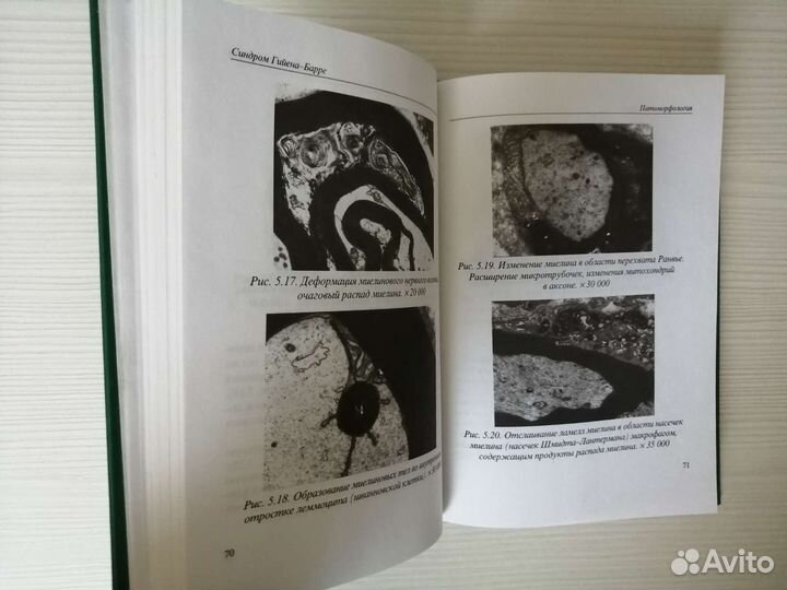 Синдром Гийена-Барре (2003г.) / М. Пирадов