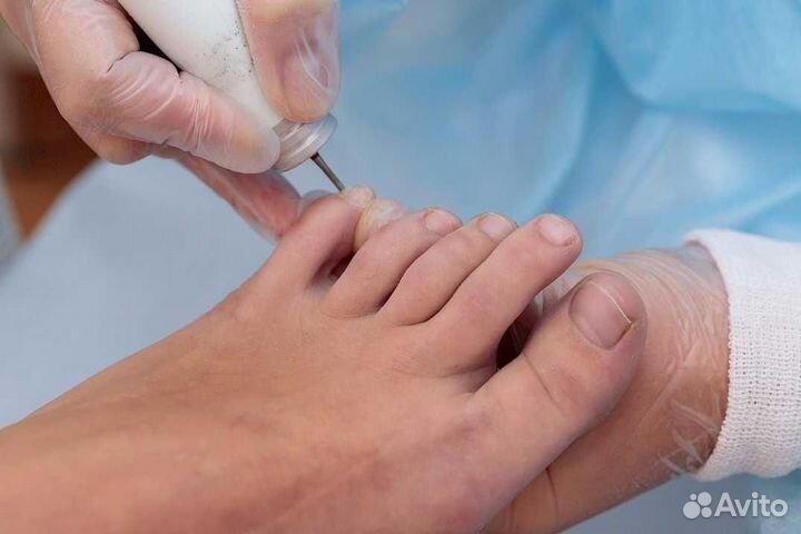 Стержневая мозоль