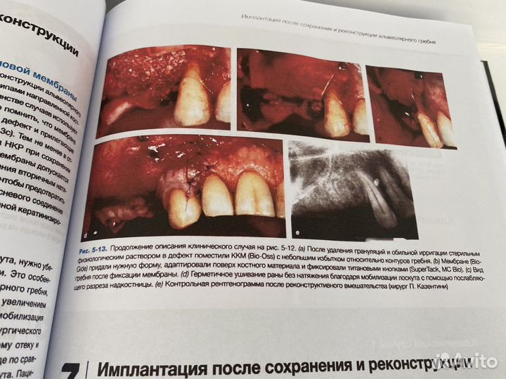 Эстетика мягких тканей в имплантологии