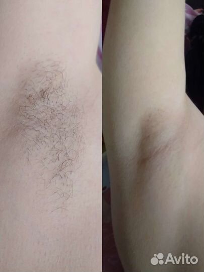 Депиляция воском: глубокое бикини