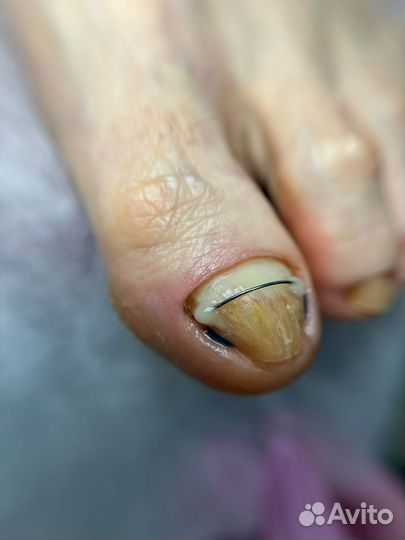Педикюр медицинский подолог