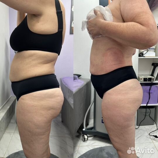 Аппаратная коррекция фигуры