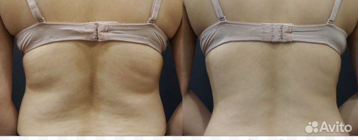 Липосакция аппаратная. Криолиполиз