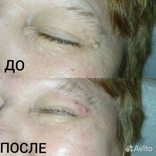 Лазерное удаление родинок, папиллом, бородавок