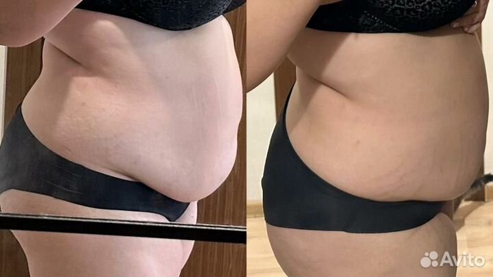 Lpg массаж, кавитация, вакуум, коррекция фигуры