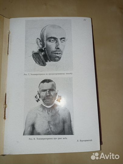 Злокачественные опухоли глоточного кольца. 1933