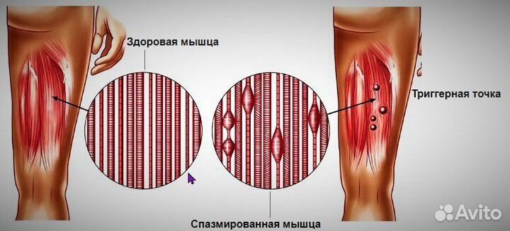Миопрессура-Юмейхо-Йога