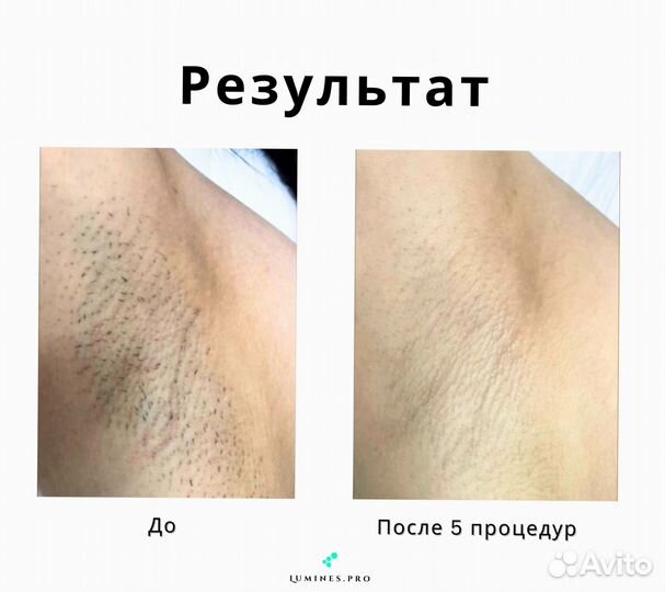 Диодный лазер для эпиляции люминес Макс’Ван 1200вт