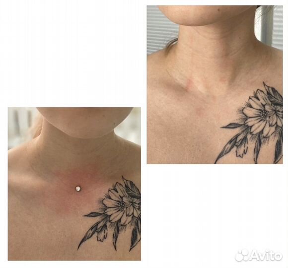 Микродермал, пирсинг