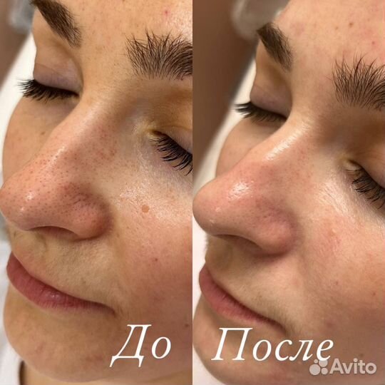 Лазерная эпиляция все тело