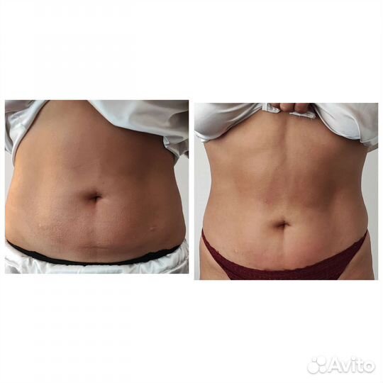 Массаж тела,массаж лица,кавитация,rf лифтинг