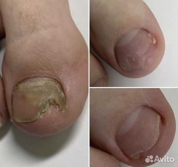 Педикюр, подолог