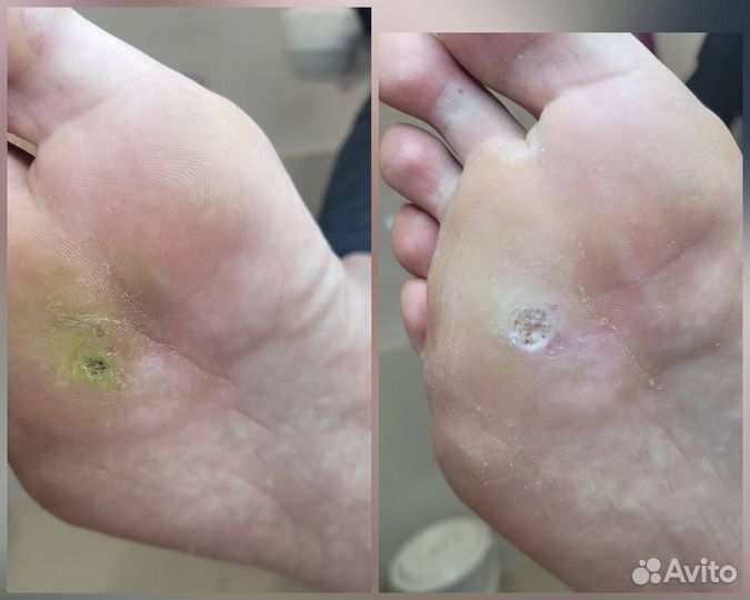 Подолог Педикюр Титановая нить