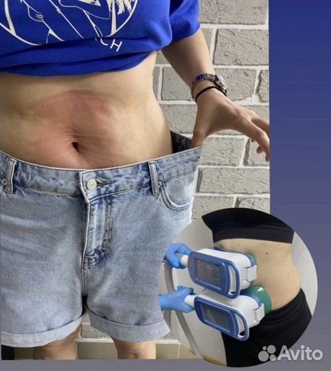 Абонемент на криолиполиз