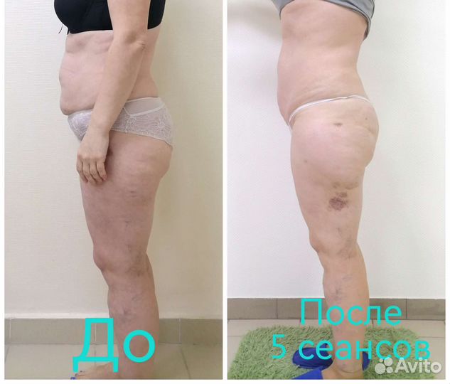 Массаж, тейпирование, rf лифтинг, кавитация