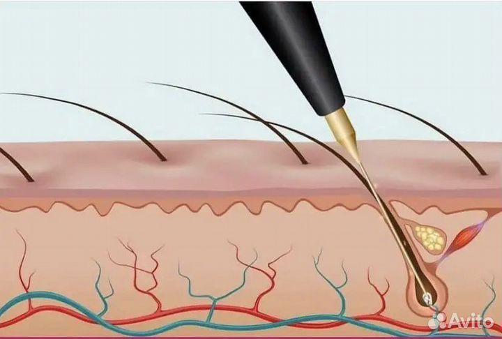 Электроэпиляция - Лазерная эпиляция