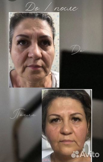 Аппаратный вакуумный массаж вибро баночный массаж