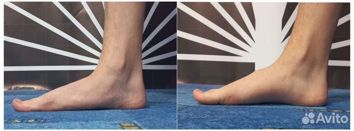 Плоскостопие, позвоночник, реабилитация