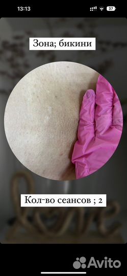 Лазерная эпиляция