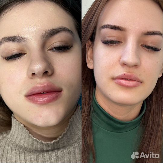 Модель на увеличение губ